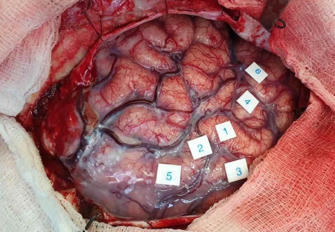 Brain mapping