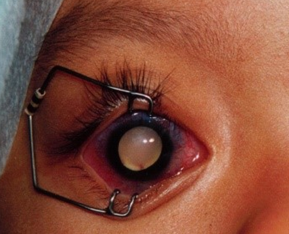 Advanced retinoblastoma, before enucleation