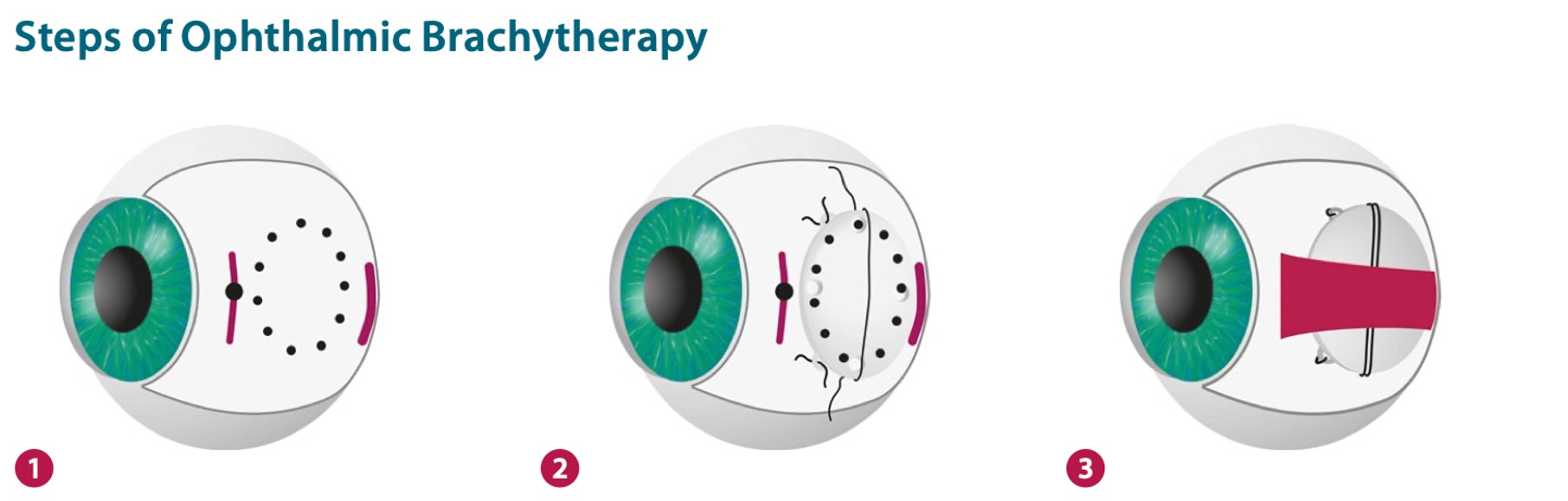 Ophthalmic Brachytherapy
