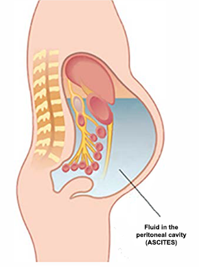 Ascites